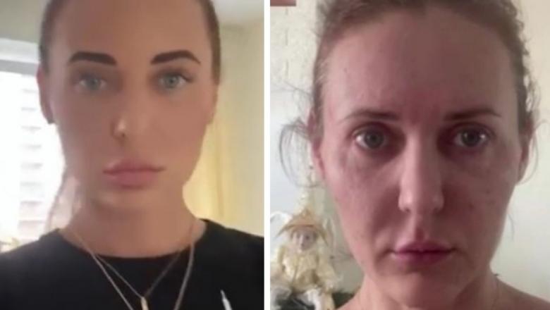За месяц постарела на 10 лет: девушка рассказала, как косметолог испортила ей внешность